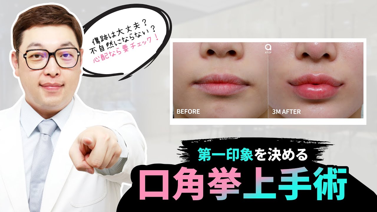 口角挙上を行うかお悩みなら？この動画で全て解決👌【エートップ美容整形外科】