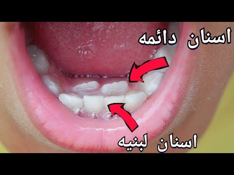فيديو: كيفية تجنب مشاكل تاج الأسنان: 13 خطوة (بالصور)