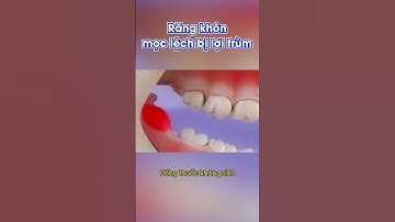Mô phỏng răng khôn lợi trùm