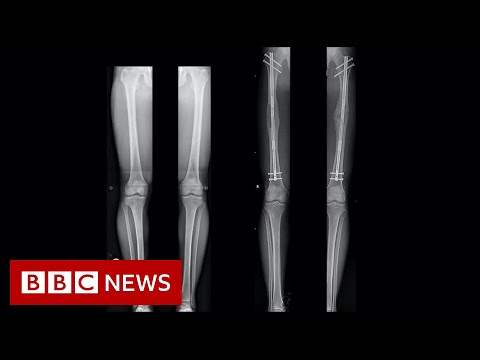 ಲೆಗ್-ಉದ್ದ: ಶಸ್ತ್ರಚಿಕಿತ್ಸೆ ಹೊಂದಿರುವ ಜನರು ಸ್ವಲ್ಪ ಎತ್ತರವಾಗಲು - BBC ನ್ಯೂಸ್