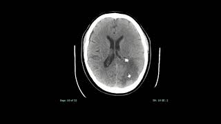 CT Head short case - Vasogenic vs cytotoxic oedema