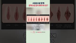 소음순수술 할 때 음핵수술 같이 해야 하나요?!