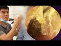ASMR耳掃除:老若男女問わずハマる“音の魔力”とは?🌀
