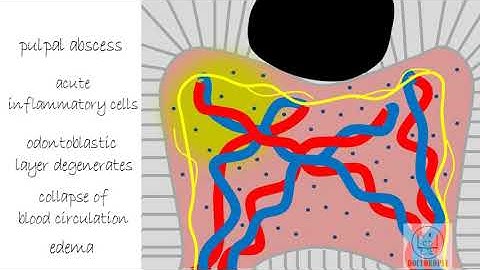 Acute Pulpitis - Diseases of Pulp [Part 3]