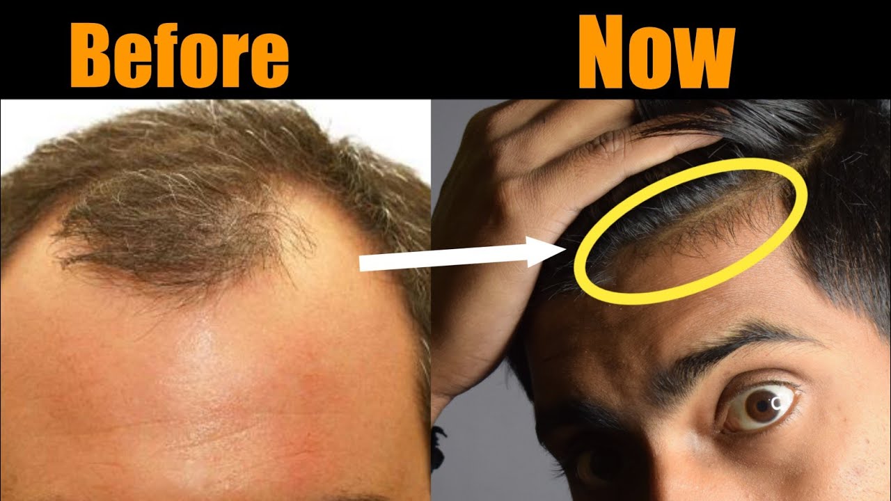 Can Hair Regrow After Hair Fall Out? क्या झड़े हुए बाल वापस आ सकते हैं? -  YouTube | Fall hair, Grow hair, Regrow hair