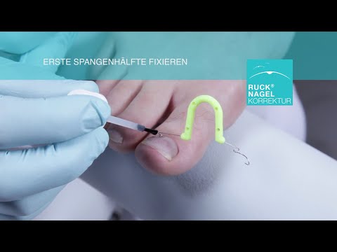 Erlernen Sie in diesem Video die richtige Applikationstechnik der Korrekturspange ORTOGRIP professional. Auf der bewährten VHO Osthold-Methode basierend, ein...