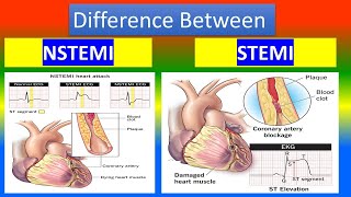 Contrast between   NSTEMI  and   STEMI