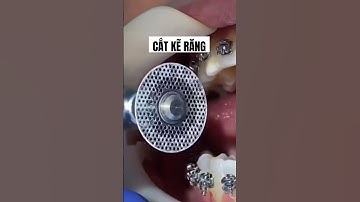 Mài kẽ Răng để niềng răng 😅😅 #rang #nhakhoa