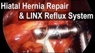 LINX & Hiatal Hernia Repair to Treat Reflux - Animation and Surgical Footage