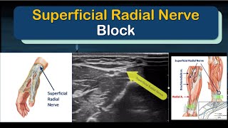 SUPERFICIAL RADIAL NERVE Block - a 