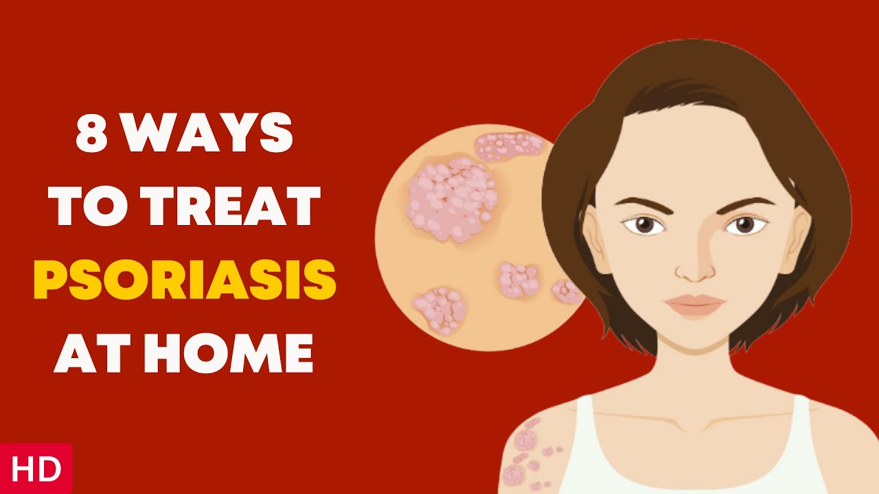 8 Ways to Treat Psoriasis at Home YouTube