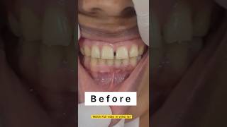 Permanent Teeth gap close by Emax crown | #mumbaidental #emax #naturally #ulwe #navimumbai