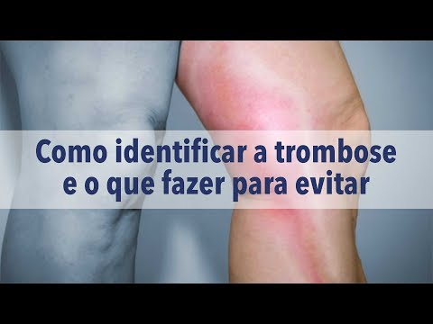 Vídeo: Dor Nas Veias Das Pernas