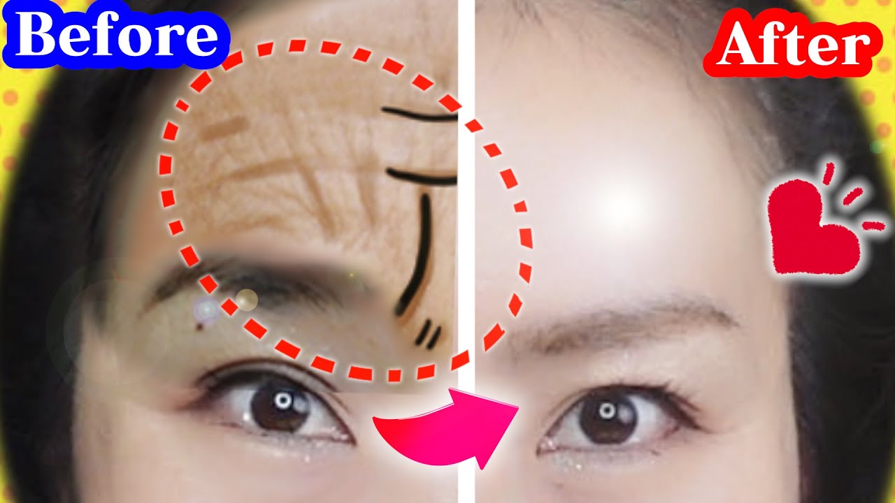 Tighten and Remove Forehead   Frown Wrinkles in 7 DAYS  Massage   Exercises