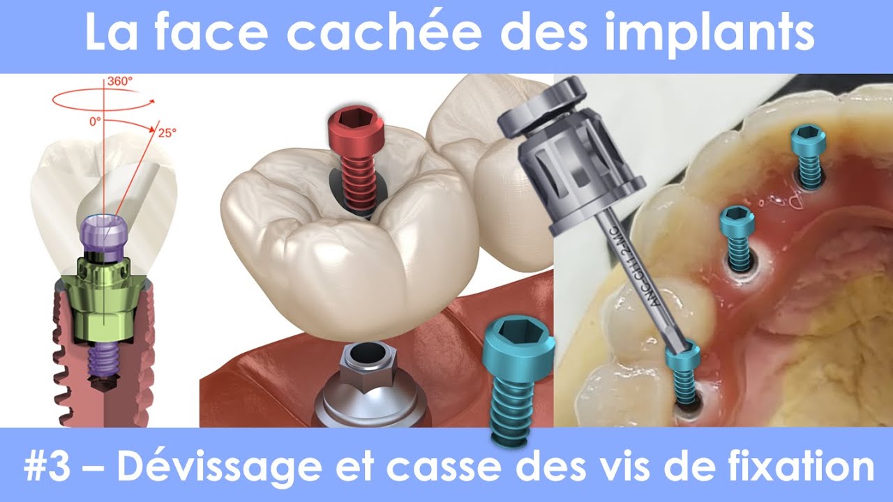 La face cachée des implants dentaires - #3 - dévissage et casse des vis de fixation
