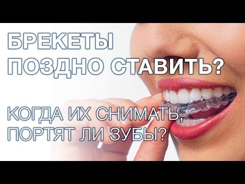 Брекеты. Портят ли зубы брекеты? Долго ли носить брекет систему?