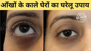 Home Remedies for Dark Circles Under Eyes (आंखों के नीचे काले घेरे के लिए घरेलू उपचार) | Dr. Dadu