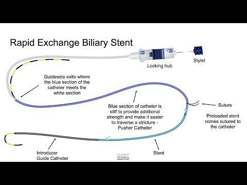 HCC 1474 19d Rapid Exchange Stent 