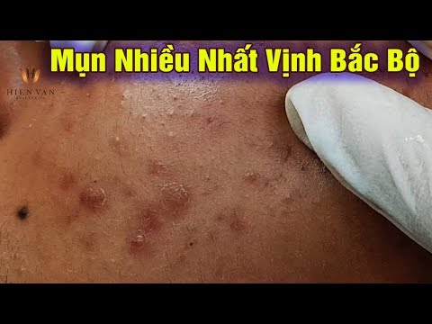 Video: 3 cách để điều trị mụn cóc Palmar