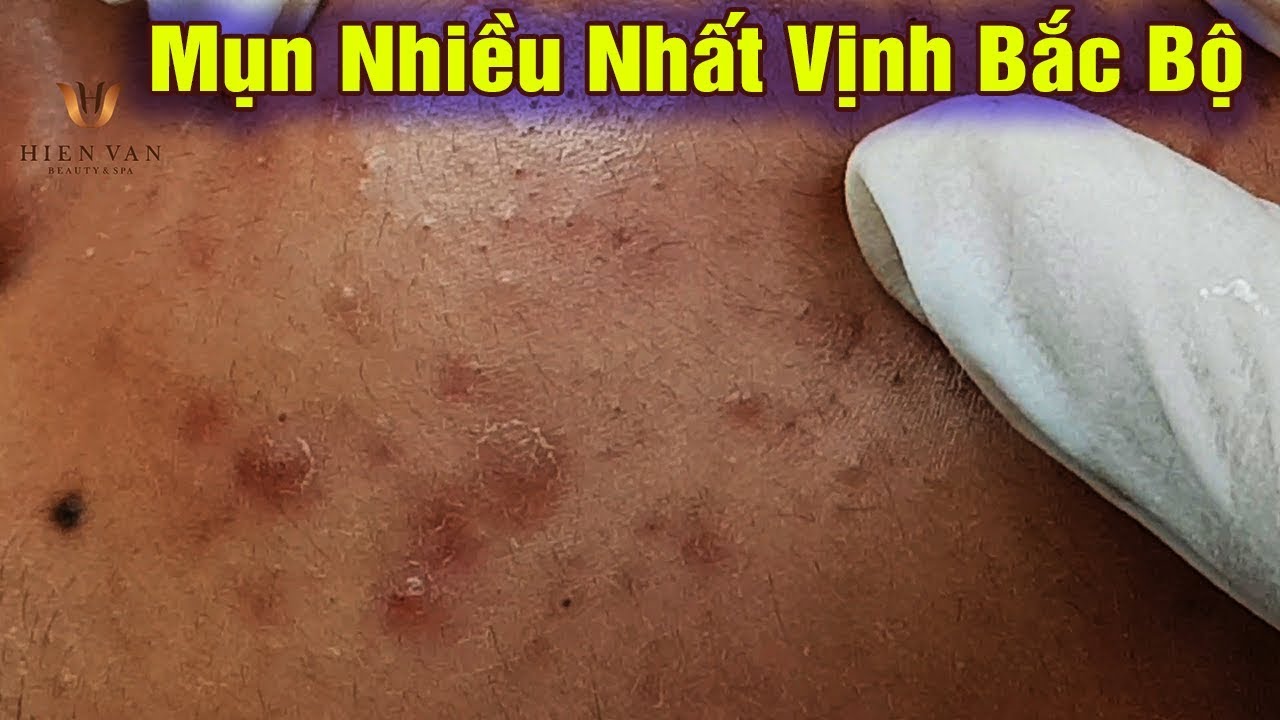 Điều trị mụn ẩn, mụn đầu đen hiệu quả uy tín. Tại Hiền Vân Spa - bài 244