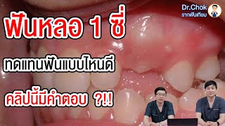 ฟันหลอ 1 ซี่ ทดแทนฟันแบบไหนดี คลิปนี้มีคำตอบ ?!! | คลายปัญหารากฟันเทียม กับ หมอโชค