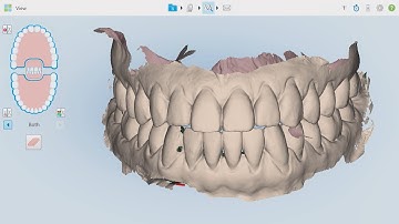 Chairside Live Episode 253: A Pre-Treatment Scan of the Upper Arch