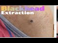 Shoulder blackhead extraction  dr steven greene in seattle