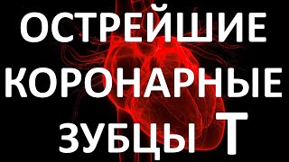 ОСТРЕЙШИЕ КОРОНАРНЫЕ Т: ПЕРВЫЙ ЭКГ ПРИЗНАК ИНФАРКТА МИОКАРДА