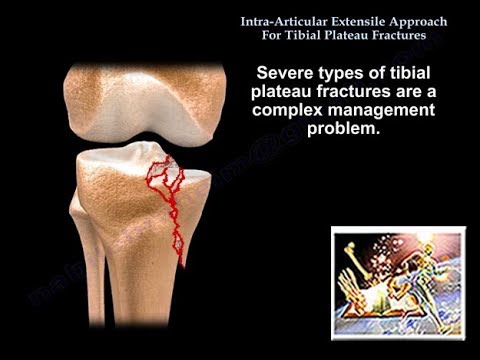 Extensile Approach Tibial Plateau Fracture Everything You Need To Know Dr Nabil Ebraheim