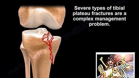 Extensile Approach Tibial Plateau Fracture - Everything You Need To Know - Dr. Nabil Ebraheim