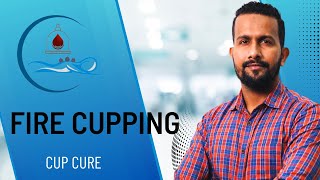 Igniting Healing Flames: The Ultimate Guide to Fire Cupping | CupCure Institute