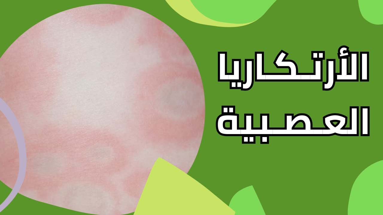 الأرتكاريا العصبية النفسية أعراضها وأسبابها وعلاجها مع د. أمجد الحداد