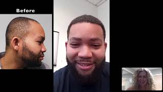 Natural Hair Transplant Video Results for Black men | Permanent Hair Restoration in Fort Lauderdale