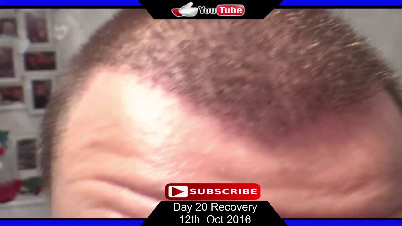 Hair Transplant Result After 20 Days  YouTube