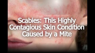 Scabies: This Highly Contagious Skin Condition Caused by a Mite