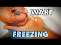 FREEZING A BIG PLANTAR WART (With Liquid Nitrogen) Ouch! | Dr. Paul