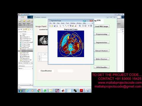 Automated Sensing of Chronic Kidney Disease Using SVM