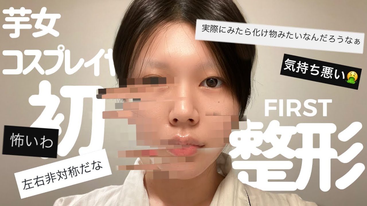 【整形】芋女コスプレイヤー整形でテーピングいらずの小顔に…。
