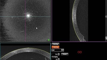 Full Cornea En-Face OCT Navigation using TOPCON Triton