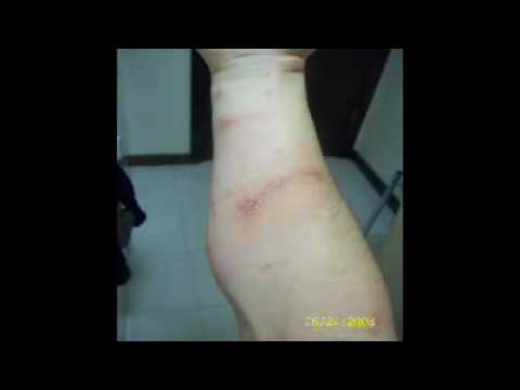 Video: Poison Oak Rash: Gambar Dan Rawatan