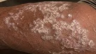 Psoriasis psoriasis skin plaques treatementofPsoriasis viralvideo