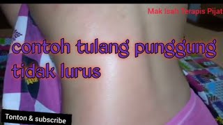 Contoh tulang punggung tidak lurus‼️ Mak Isah Terapis Pijat