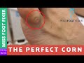 The Perfect Corn Removal | Miss Foot Fixer | Marion Yau