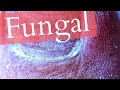 CLOSE UP | FUNGAL TOENAIL TREATMENT | TITANIUM WIRE SYSTEM | ORTHONYXIA | УСТАНОВКА ТИТАНОВОЙ НИТИ |