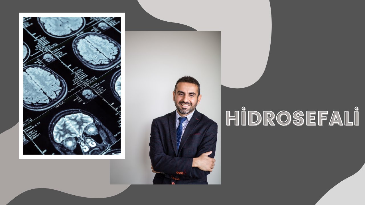 Накопление жидкости при лечении гидроцефалии в головном мозге