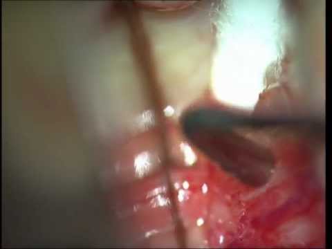 WINDOW TO THE WORLD-OPTIC NERVE SHEATH FENESTRATION SOOSAN