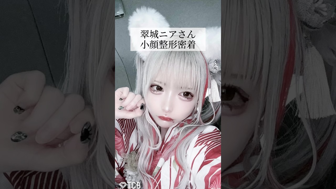 糸リフト】小顔整形に密着✨ - YouTube 糸リフト】小顔整形に密着✨ - YouTube