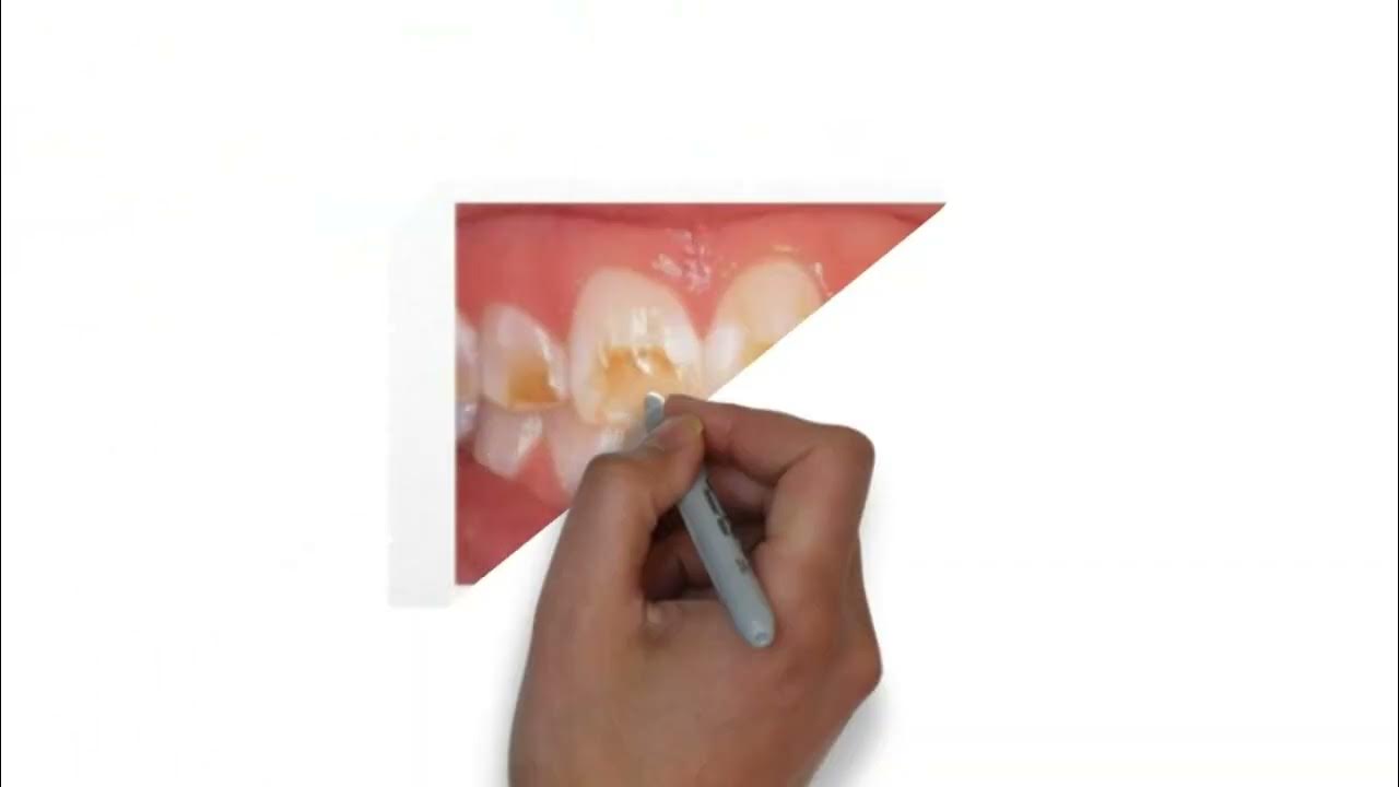 MICROABRASION YouTube