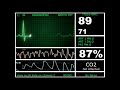 Hospital monitor with flatline l