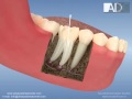 Root canal treatment and post core application